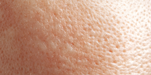 Skin Integrity- Pressure Sores/Ulcers